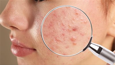 طرق علاج حب الشباب بسرعة.. روشتة علاجية من الصيدلية 