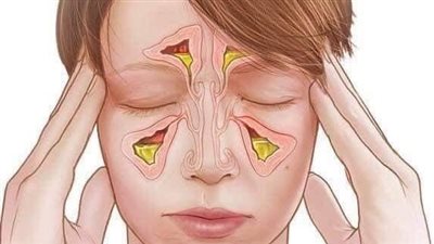التهاب الجيوب الأنفية المزمن.. الاعراض وطرق العلاج المنزلية 