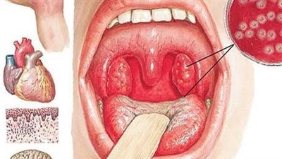 أخطاء شائعة عن الحمى الروماتيزمية.. ما هي؟
