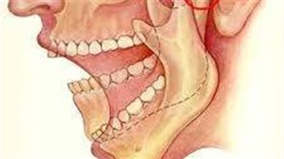 اعراض التهاب مفصل الفك الصدغي.. توقف عن قضم أظافرك!