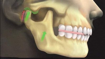 علاج صرير الاسنان بالبوتكس..جرعات مخففة تخلصك من الحالة