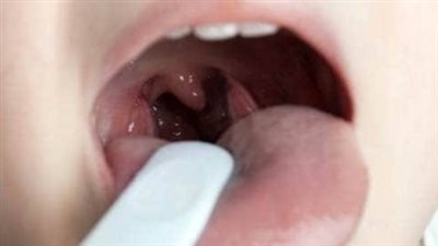 التهاب الحلق الفيروسي والبكتيري عند الأطفال.. اعراضهما والفرق بينهما 