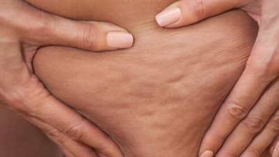 ما هو جلد البرتقال؟.. ولماذا هو محرج للسيدات؟ 
