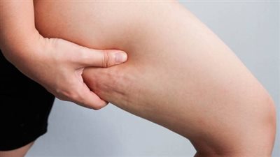 أسباب ظهور السيلوليت في الفخذين.. قلة النشاط وعدم الحركة أبرزها