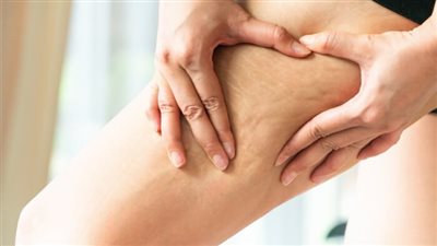 علاج السيلوليت بالميزوثيرابي.. أفضل العلاجات وأكثرها فعالية