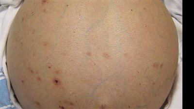 علاج استسقاء البطن.. وطرق الوقاية منه بالطعام