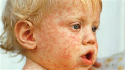 متى يكون فيروس الحصبة خطيرا؟.. حالات وفاة نادرة