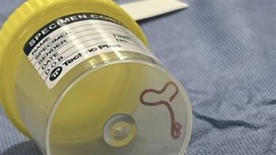 استخراج دودة من مخ سيدة استرالية بطول 8 سم يثير ردود فعل واسعة على وسائل التواصل الاجتماعي