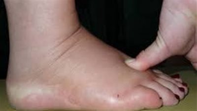 زلال الحمل.. ما شكله؟ وهل هو خطير؟