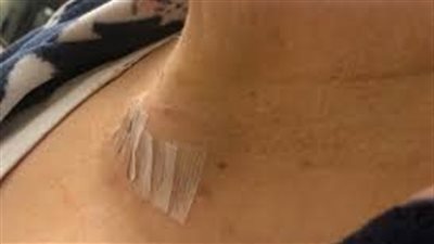 كيف يكون شكل الرقبة بعد جراحة الغدة الدرقية؟
