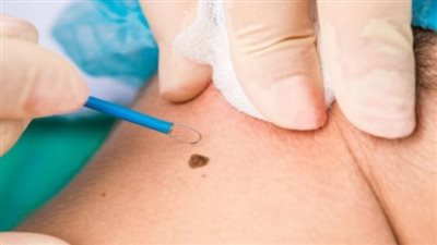 أسباب وأعراض الورم الحليمي.. وطرق العلاج وكيفية معرفه بداياته
