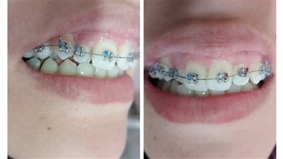 فوائد تقويم الأسنان.. تحسين القدرة على الكلام