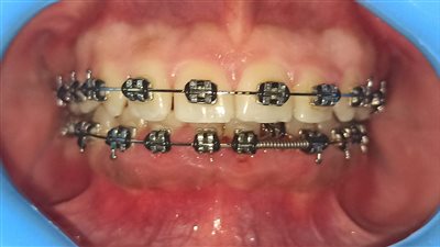 المرحلة السنية المناسبة لتقويم الاسنان.. خلال الطفولة أكثر سهولة