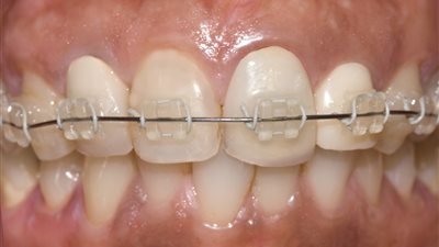 تقويم الاسنان الخزفي.. هل يعطى شكلا أجمل؟ 