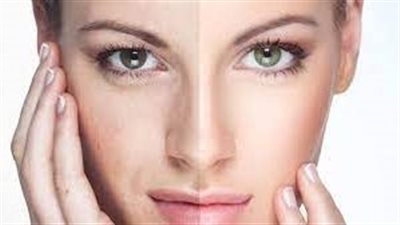 حقن الجلوتاثيون.. أحد التقنيات الحديثة لتفتيح البشرة والجسم