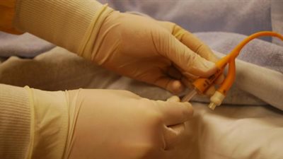 أعراض انسداد مجرى البول.. انتفاخ المثانة عرض اساسي 