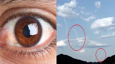 ما هي عوائم العين؟.. أعراضها وأسبابها 