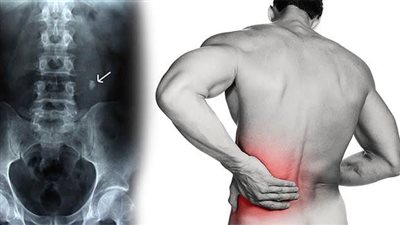 أعراض المغص الكلوي المتكرر.. انتبه لنزول الدم في البول