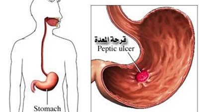 أفضل أدوية قرحة المعدة.. تستهدف تقليل الأعراض