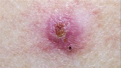 ما هو مرض الليشمانيا وهل هو خطير؟