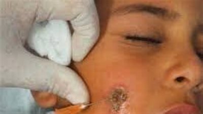 كيف يتم مرض تشخيص الليشمانيا؟..عينات القروح والنخاع الشوكي