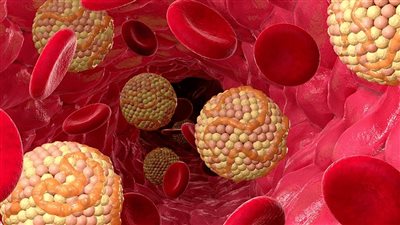 أعراض ارتفاع الكوليسترول عند النساء.. 5 علامات أساسية وإليكم نسب الكوليسترول الطبيعية