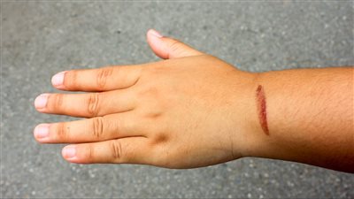 علاج الحروق السطحية بـ 5 خطوات آمنة.. الإسعافات الأولية للحرق البسيط