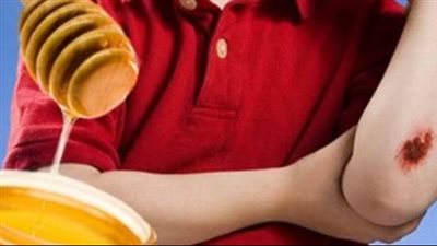 علاج الحروق السطحية بالعسل.. طريقة استخدامه ومدة وضعه على الحرق