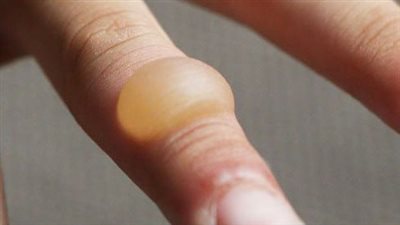 علاج سحري للحروق من الدرجة الأولى.. 5 مكونات منزلية تقلل التهاب الجلد