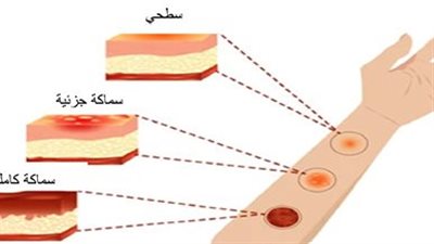أنواع الحروق بدرجاتها الأربعة ومراهم لعلاجها.. تجنب 8 أخطاء علاجية