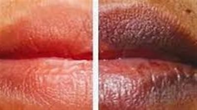 طرق توريد الشفاه.. الحمية الصحية الأفضل 