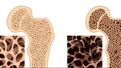 ما هو السبب الرئيسي في هشاشة العظام؟.. وكيف يمكن علاجه بالأكل؟