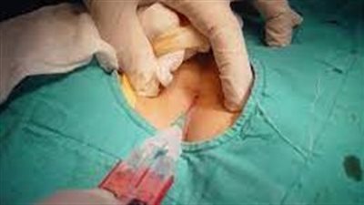 خطورة الناسور العصعصي.. استشاري يوضح