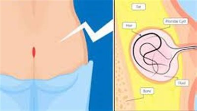 ما هي طرق علاج الناسور العصعصي؟.. الاعتناء بالنظافة الشخصية