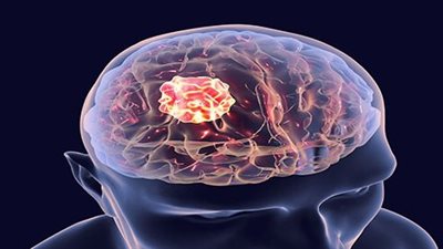 أورام المخ الخبيثة.. أنواعها وأخطر درجاتها 