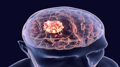 بعد إصابة الدكتور هاني الناظر.. أعراض سرطان المخ بالتفصيل.. 15 علامة مقلقة