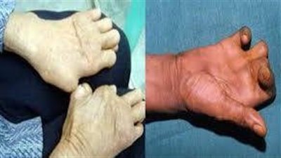 لقاح ضد مرض الجزام.. هل أصبح الحلم حقيقة؟