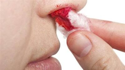 أسباب نزيف الأنف.. متى يكون خطيرا؟
