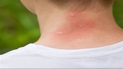 شكل قرصة بق الفراش والفرق بيها وبين قرص الناموس.. 3 علامات أساسية