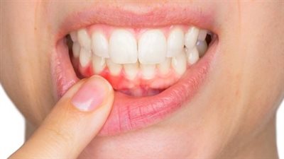 هل خل التفاح يعالج التهاب اللثة؟.. الدراسات الطبية تجيب وتوضح