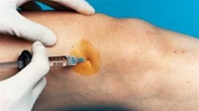 علاج داء السوفان بحقن الفيلر.. احد الحلول الناجحة