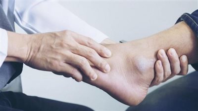 طرق علاج داء باجيت.. الأدوية ثنائية الفوسفات اكثرها نجاعة 