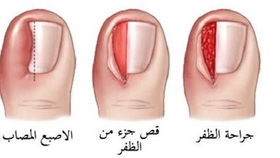 اسباب ظهور الظفر الغائر.. مشكلة شائعة في الاقدام