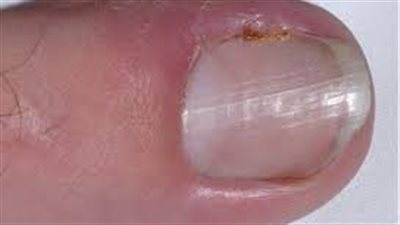 اعراض الظفر المنغرس.. تورم الاصابع وظهور الصديد