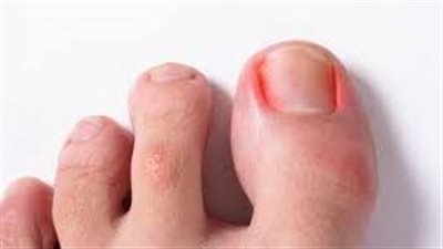 طرق الوقاية من الظفر المنغرس..لاتبالغ في تهذيب أظافرك