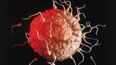 ما هي أسباب متلازمة كلاينفلتر؟.. وما طرق علاجها؟