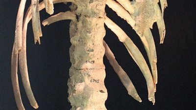 التهاب الفقار الروماتويدي.. ما هو وما اعراضه؟ 