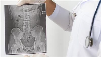 التهاب الفقرات اللاصق.. هل له علاج شاف؟