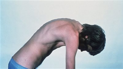 مضاعفات التهاب الفقار اللاصق.. هل هى خطيرة؟