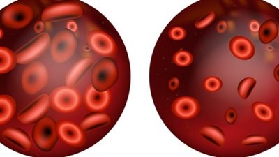 أعراض الأنيميا وعلاجها.. 10 علامات أساسية تشير لفقر الدم